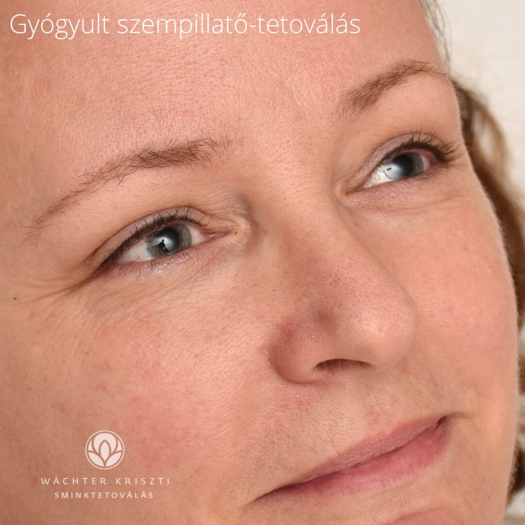 Gyógyult szempilla-tősűrítés